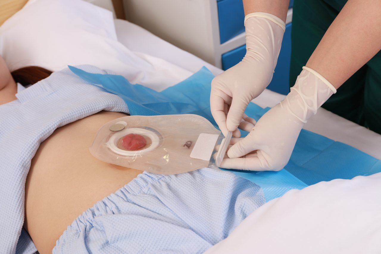 Stoma Care